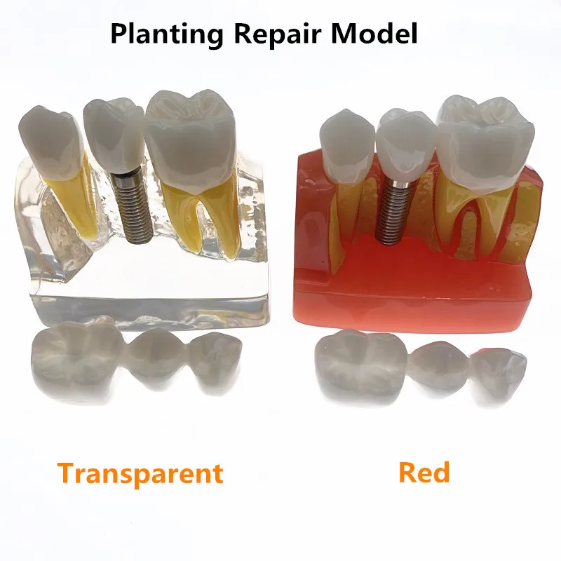 Стоматологический Обучающий анализ имплантатов Съемная модель корончатого моста Демонстрационная модель зубов